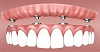dental implant